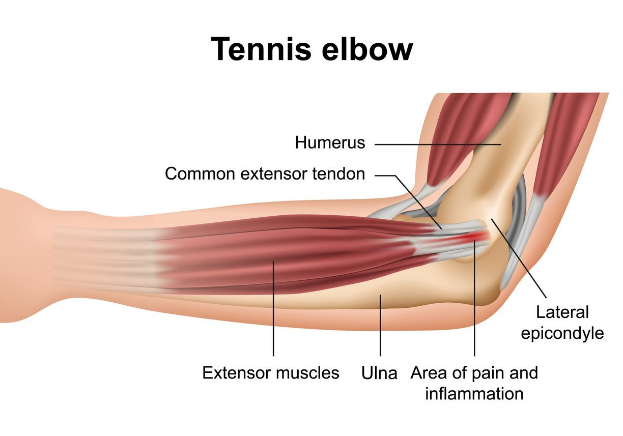 tennis elbow treatment in delhi